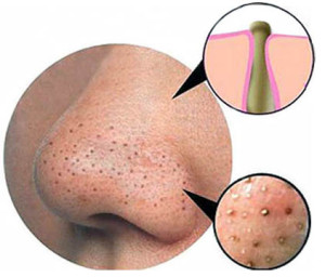 How to get rid of blackheads on nose